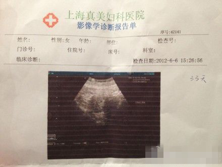 孕早期b超初期图片