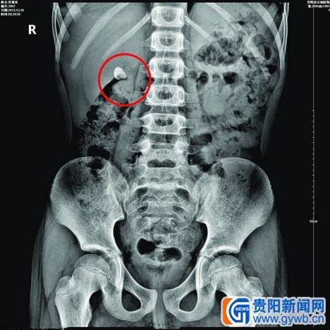 膀胱结石b超报告图片图片
